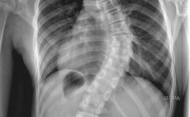 Chiropractic & Scoliosis