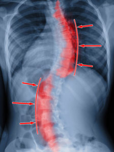 Scoliosis x-ray in Denver Colorado